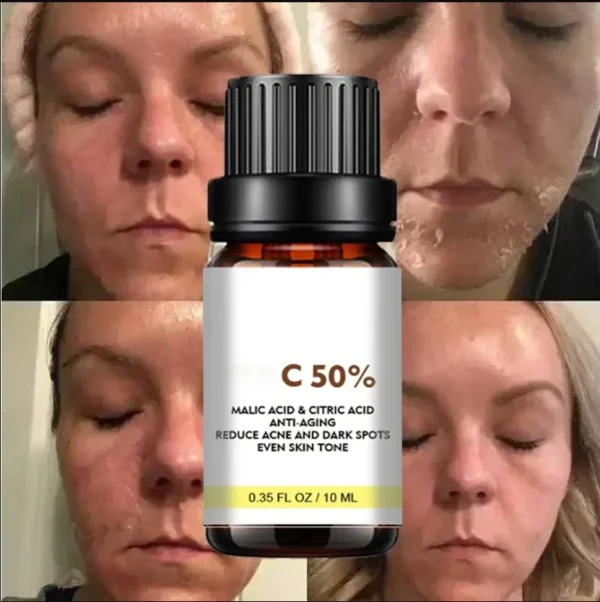 S616d864391834871bb8bee983c8066b6B.webp Dilute melanin, acne, 50% TCA, high-quality chemical exfoliation, acidic skin beauty care