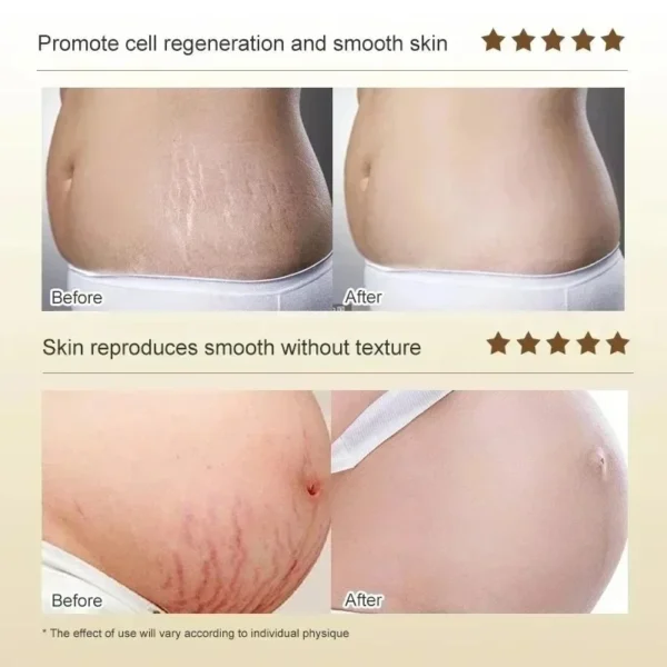 S62732817da1a49f2b165f7dfb7e275d8M.webp Cream For Pregnancy Stretch Marks Removal Eliminate Red White Old Stretch Marks 2025