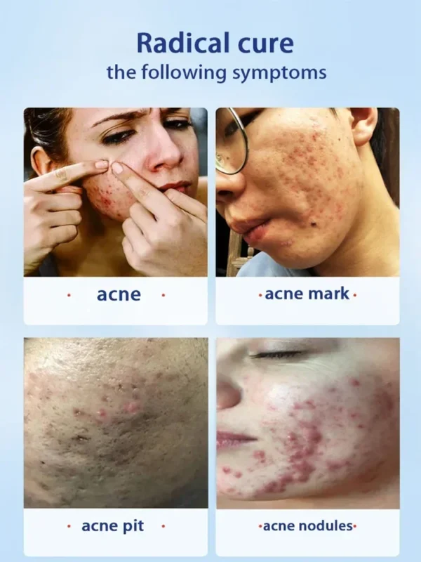 S9b871fd69ae04087a18ba6ccf245db0b0.webp 07-Salicylic Acid Solution Essence Shrink Pores and Acne Spot Removing Shrink Pores Oil-Control Brighten Face Skin Makeup