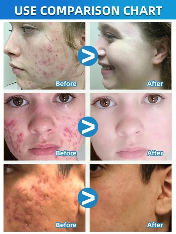 Sad7bf86792754d00997f04b5785f40e0l.webp 07-Salicylic Acid Solution Essence Shrink Pores and Acne Spot Removing Shrink Pores Oil-Control Brighten Face Skin Makeup