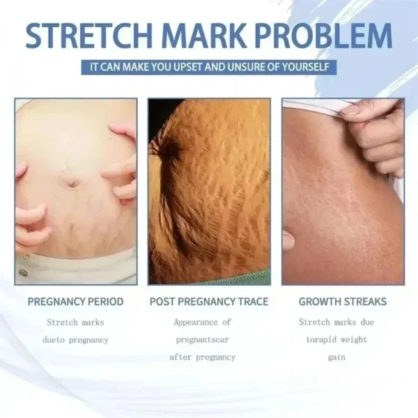 Sd56af6910b5549b2859df0e2afae109bf.webp Cream For Pregnancy Stretch Marks Removal Eliminate Red White Old Stretch Marks 2025