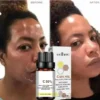 Sffcbdbf981be44a2b39fa2d08ba50312i.webp Dilute melanin, acne, 50% TCA, high-quality chemical exfoliation, acidic skin beauty care