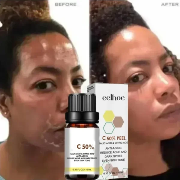 Sffcbdbf981be44a2b39fa2d08ba50312i.webp Dilute melanin, acne, 50% TCA, high-quality chemical exfoliation, acidic skin beauty care